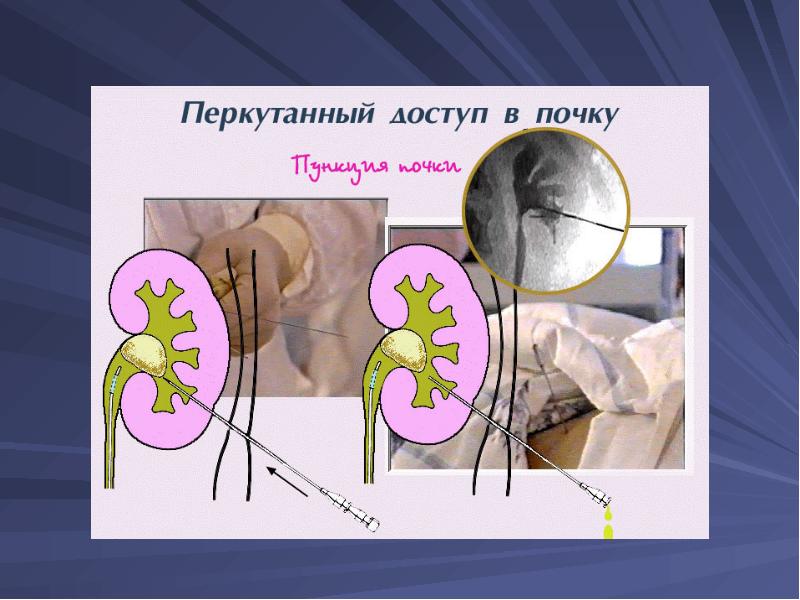 Презентация по мочекаменной болезни