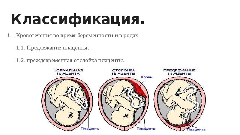 4 1 1 роды. Классификация кровотечений при беременности. Предлежание плаценты двойня. Предлежание плаценты 1ст. Предлежание плаценты мкб.