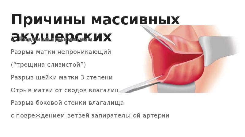 Презентация на тему акушерское кровотечение