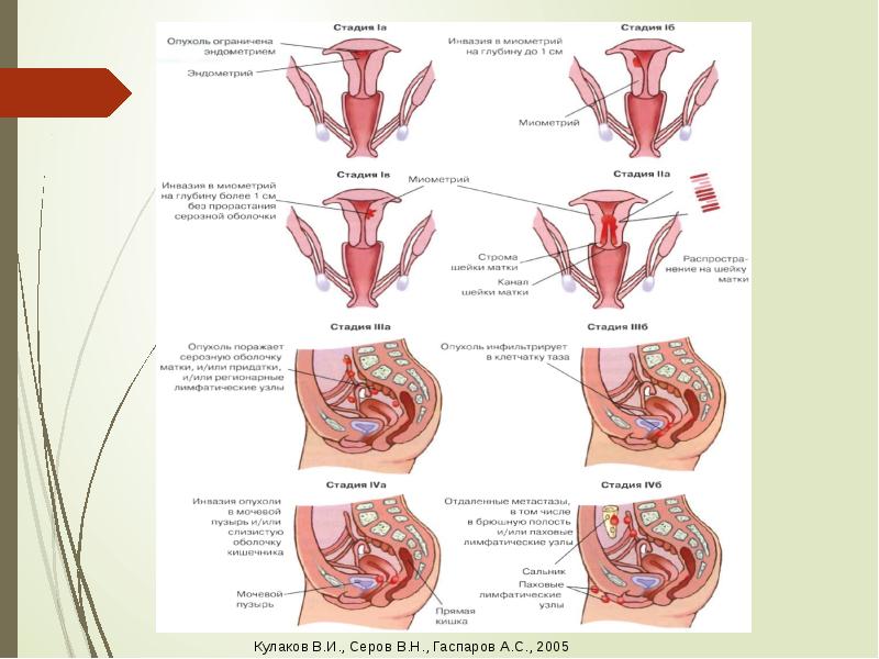 Рак тела матки презентация