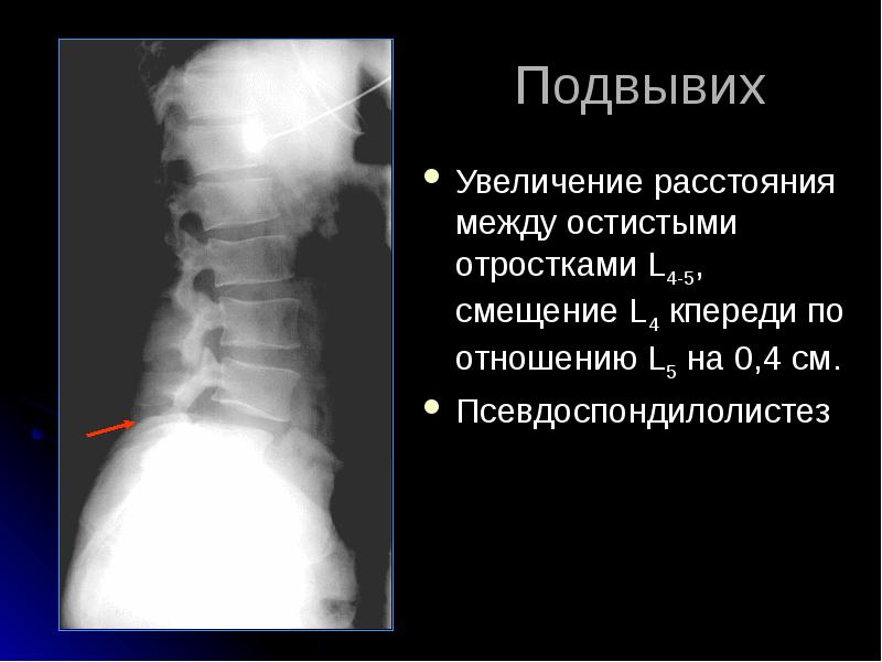 Лучевая диагностика позвоночник презентация