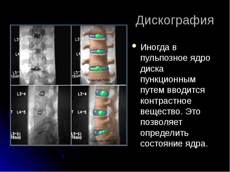 Лучевая диагностика позвоночник презентация