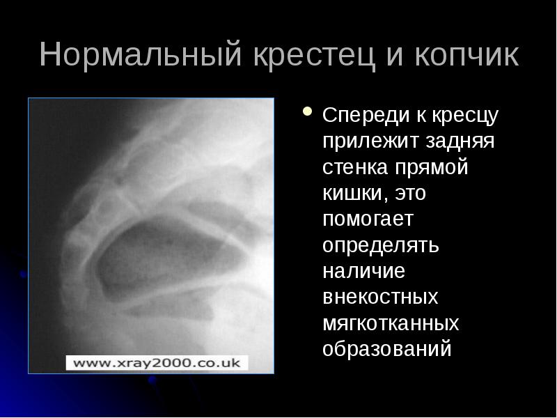 Лучевая диагностика позвоночник презентация