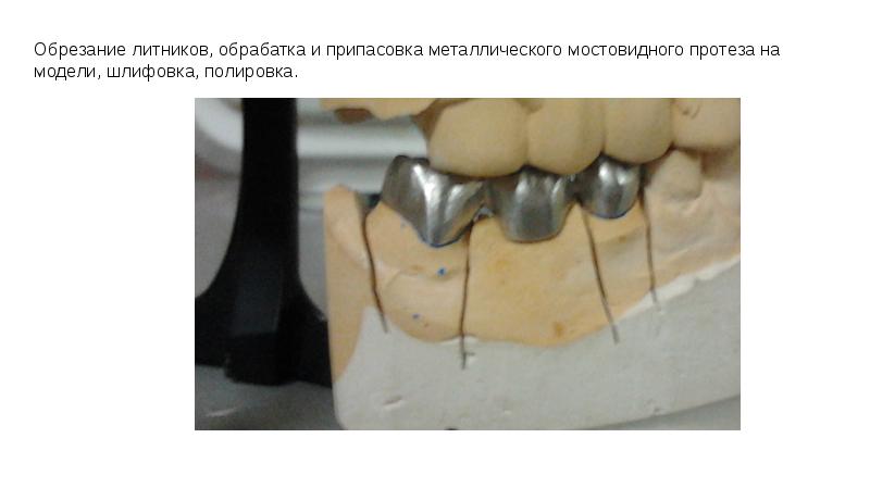 Изготовление мостовидных протезов презентация