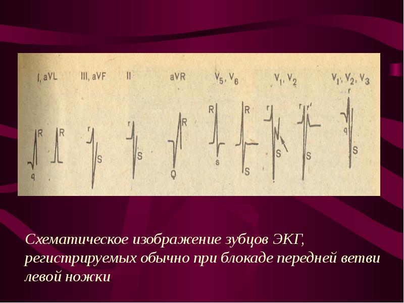 Блокада передней ветви левой ножки пучка Гиса. ЭОС при блокаде левой ножки.