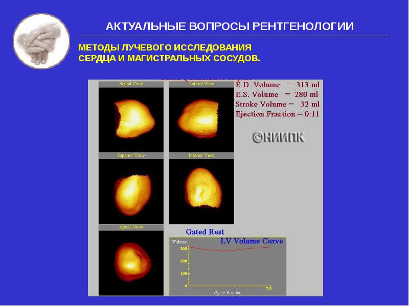 Методы лучевого исследования сердца и сосудов презентация