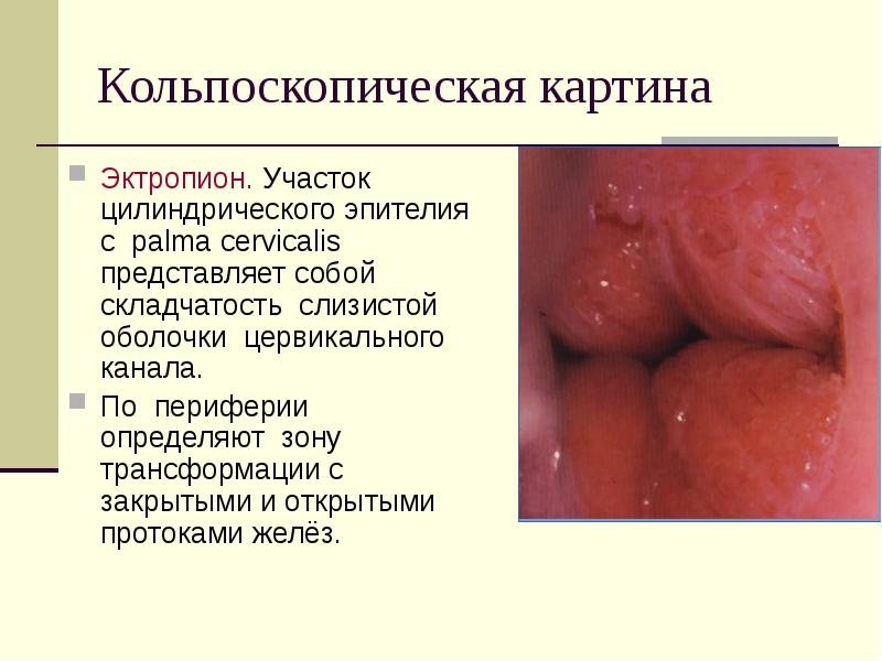 Абнормальная кольпоскопическая картина