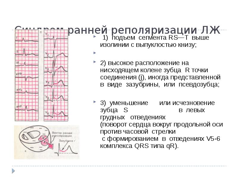 Синдром ранней реполяризации желудочков презентация