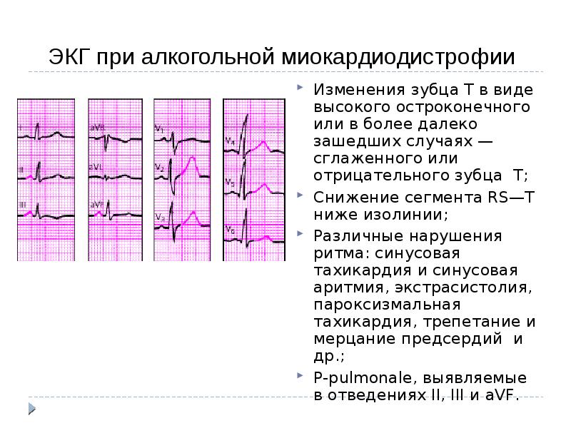 Ишемия нижней стенки на экг что это значит