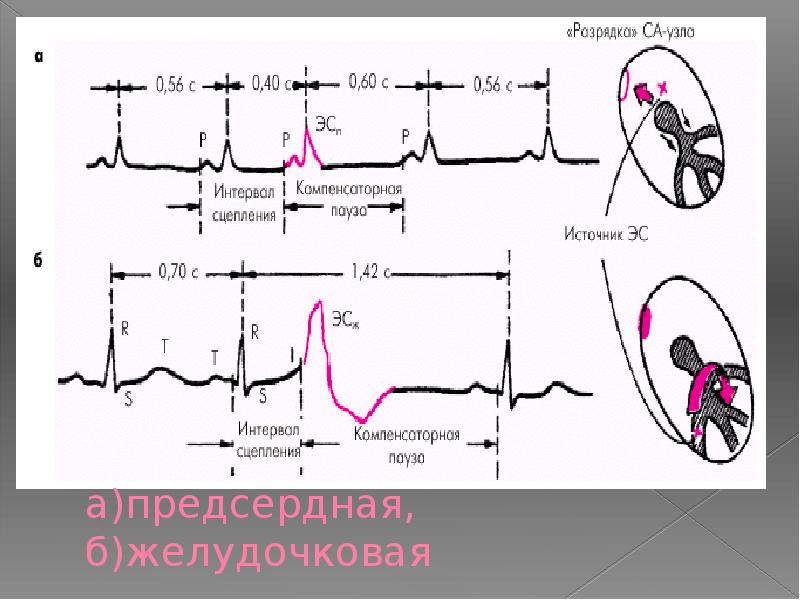 Нарушение предсердной проводимости. Жизнеугрожающие нарушения ритма и проводимости сердца. Предсердный ритм нарушение проводимости. Нарушение 3 предсердной проводимости.