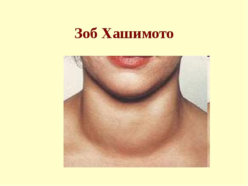 Зоб Хашимото