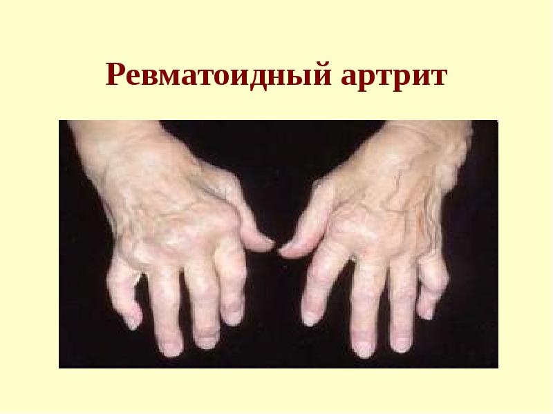 Ревматоидный артрит