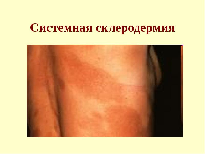 Системная склеродермия