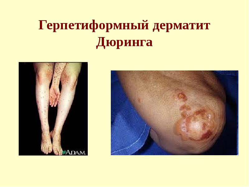 Герпетиформный дерматит Дюринга