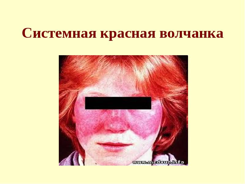 Системная красная волчанка