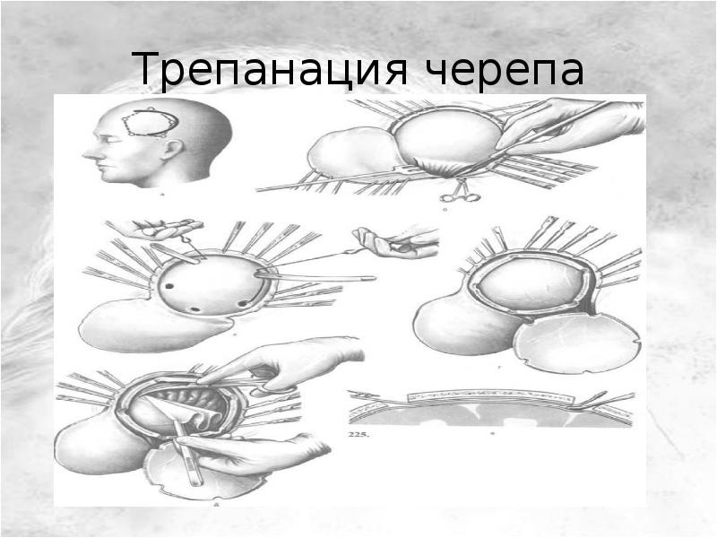 Схема трепанации черепа по способу оливекрона