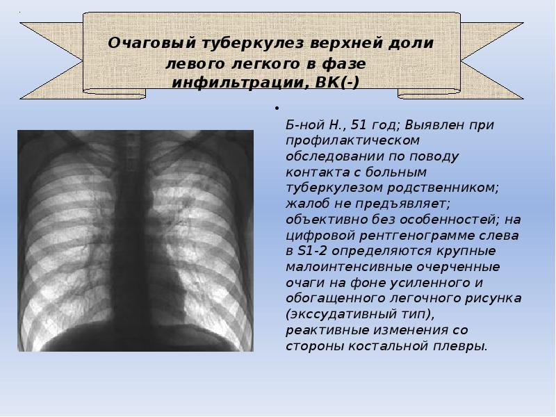 Очаговые легких. Очаговый туберкулез легких в фазе инфильтрации рентген. Очаговый туберкулез в фазе инфильтрации рентген. Очаговый туберкулез легких рентген описание. Рентген стадии очагового туберкулеза.