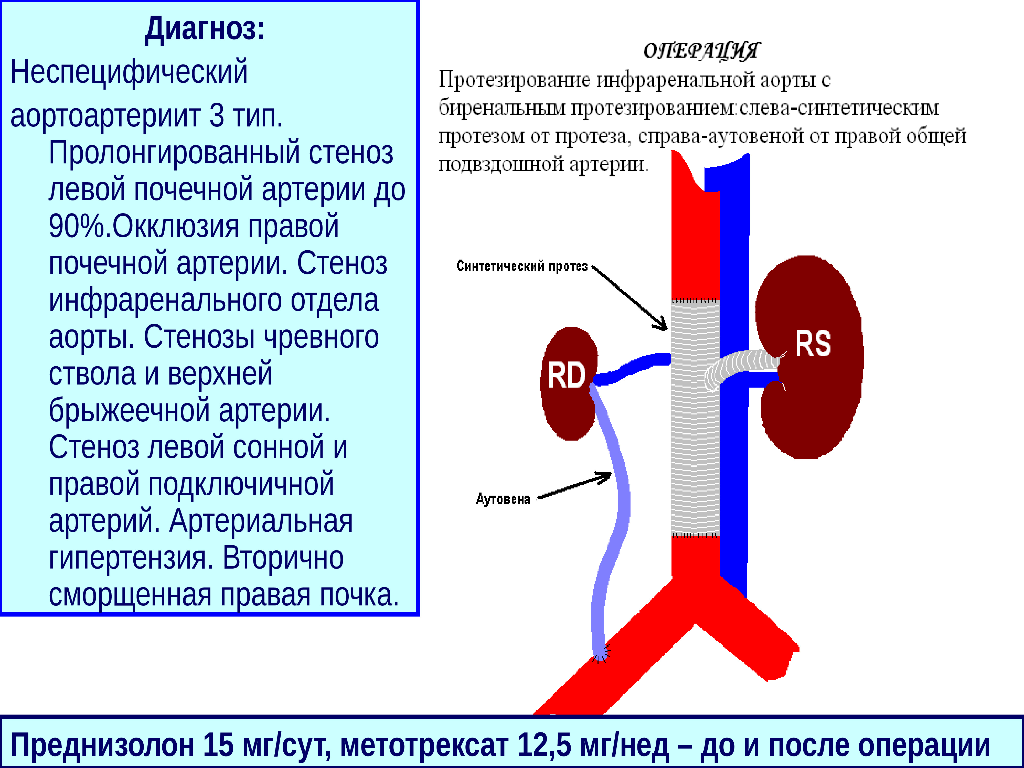 Неспецифический аортоартериит презентация