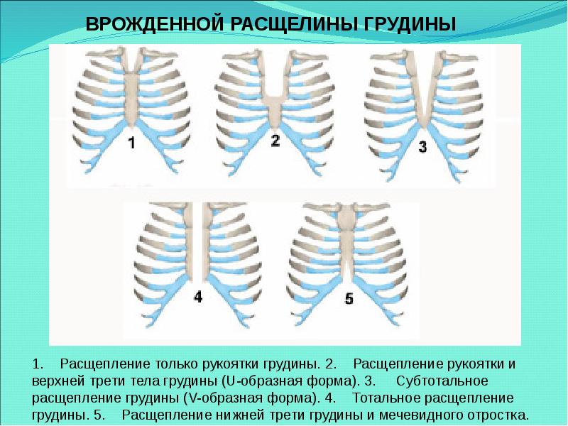 Трети грудины. Врожденная расщелмна груди. Врожденная расщелина грудины. Расщепление рукоятки грудины.