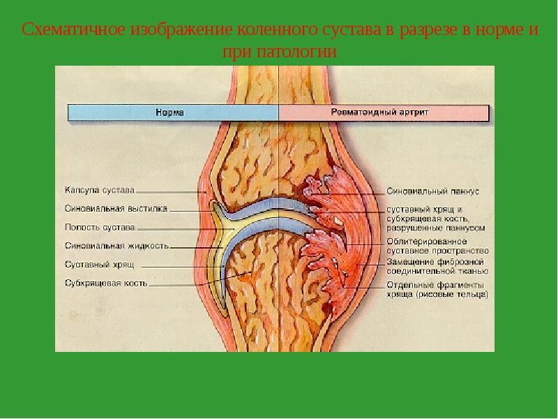 Нормальный сустав. Ревматоидный артрит коленного сустава. Коленный сустав схематично. Коленный сустав в разрезе.