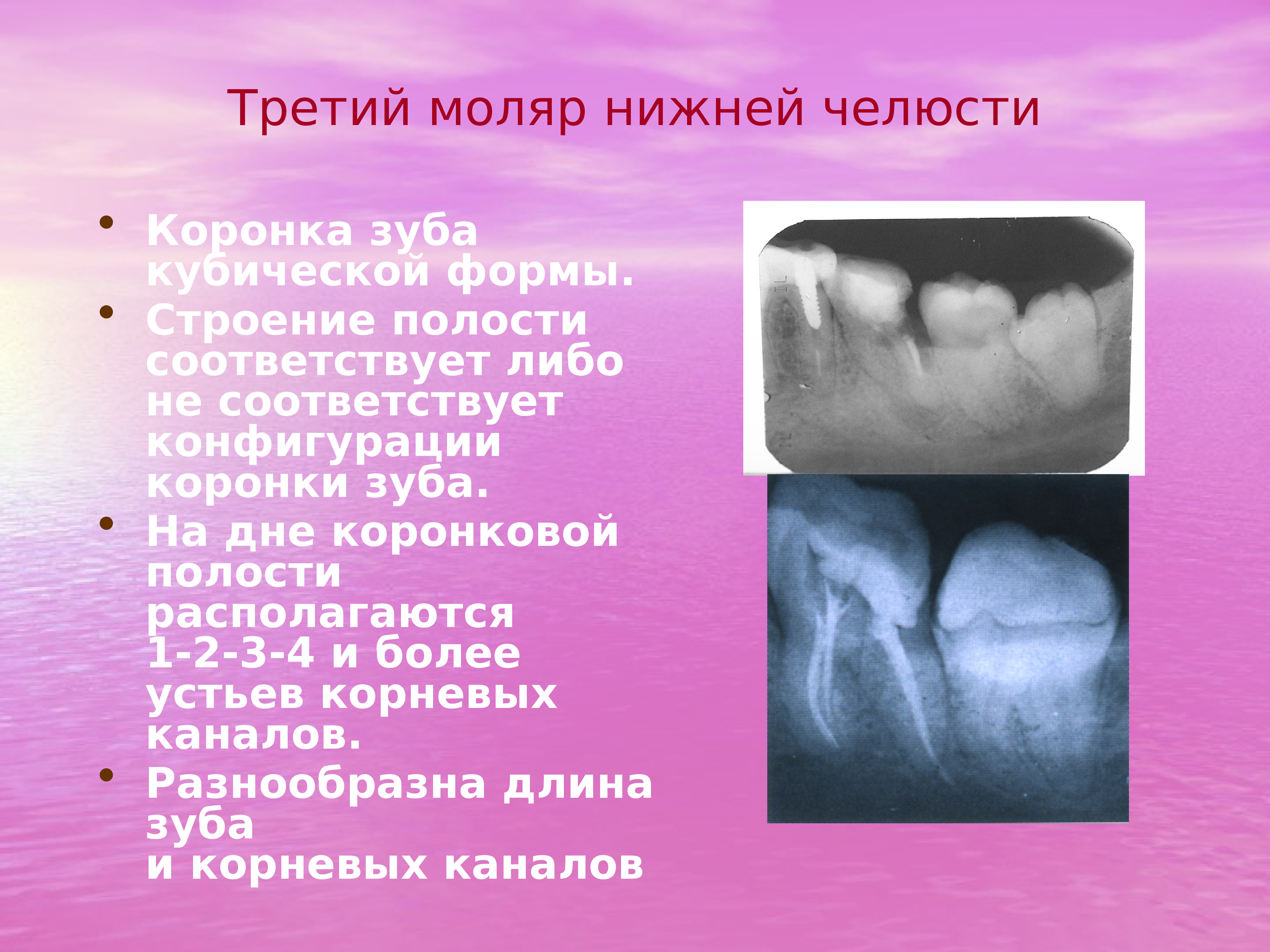 Трети зуба. Форма полости моляров нижней челюсти:. Строение второго моляра нижней челюсти. 3 Моляр нижней челюсти.