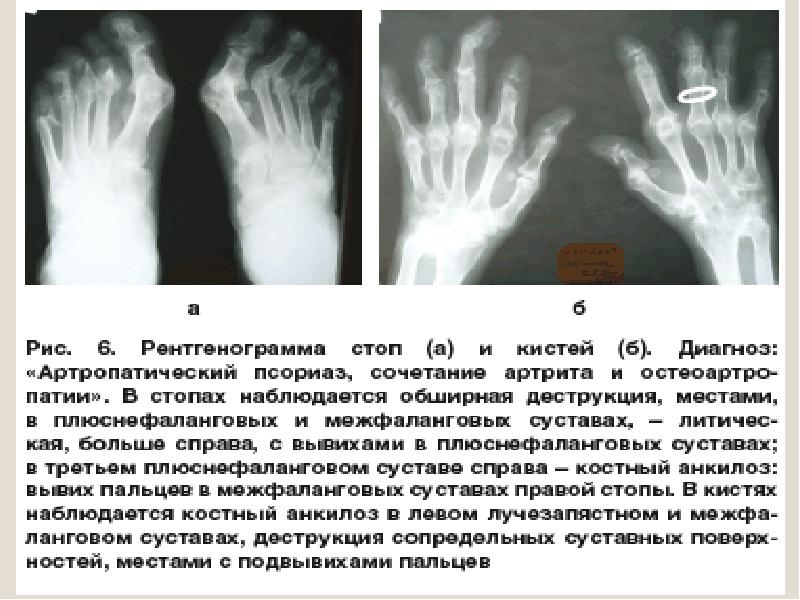 Аномалии суставов. Возможные диагнозы кистей на рентгене. Вывих левой кисти диагноз.