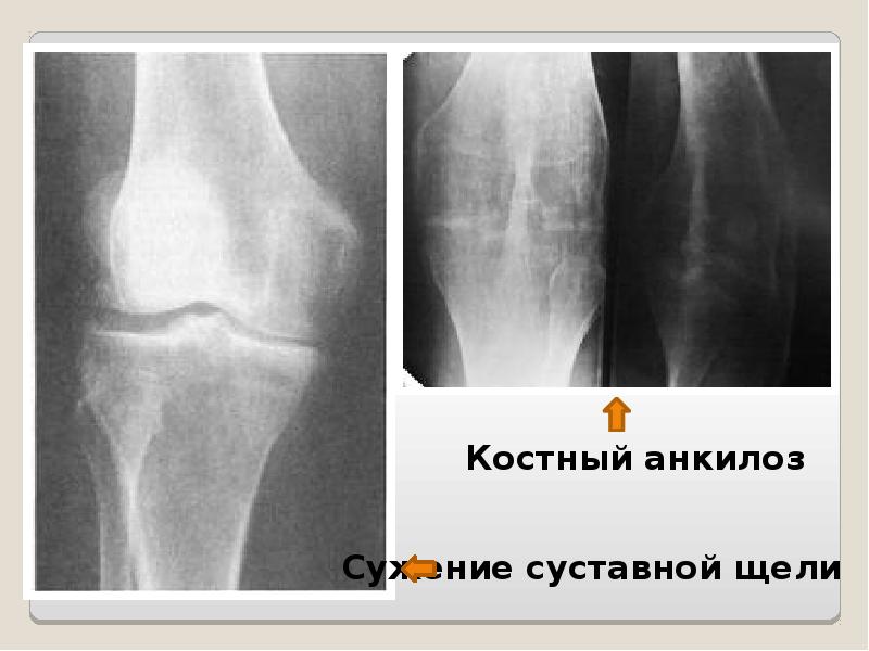 Анкилоз это. Суставная щель акс. Сужение суставной щели. Суставная щель асимметрия.