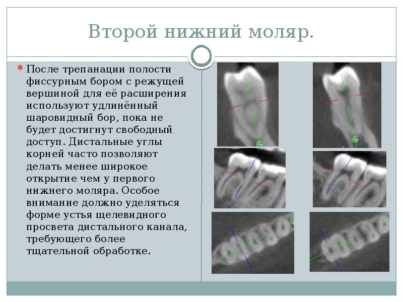 Эндосистемы в стоматологии презентация