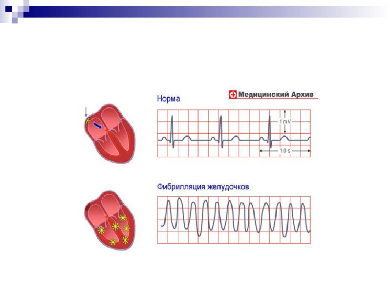 Противоаритмические средства презентация