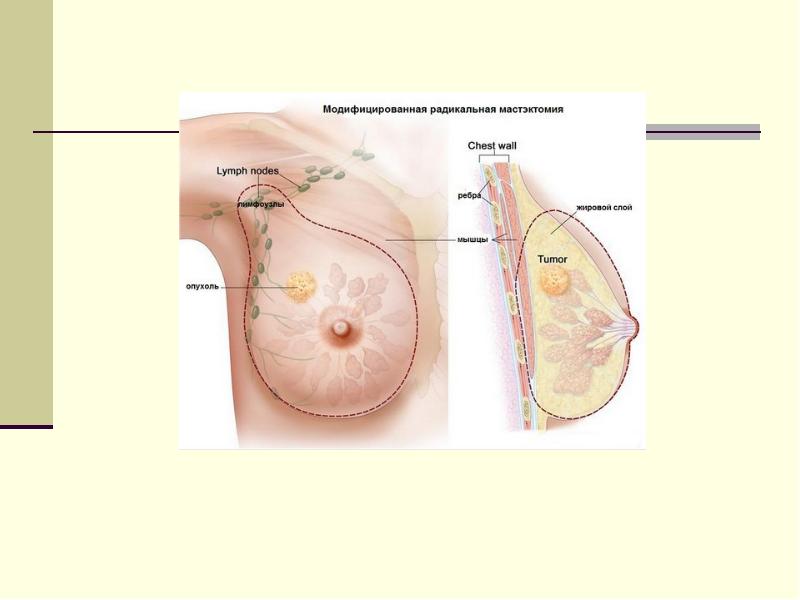 Рак груди в картинках