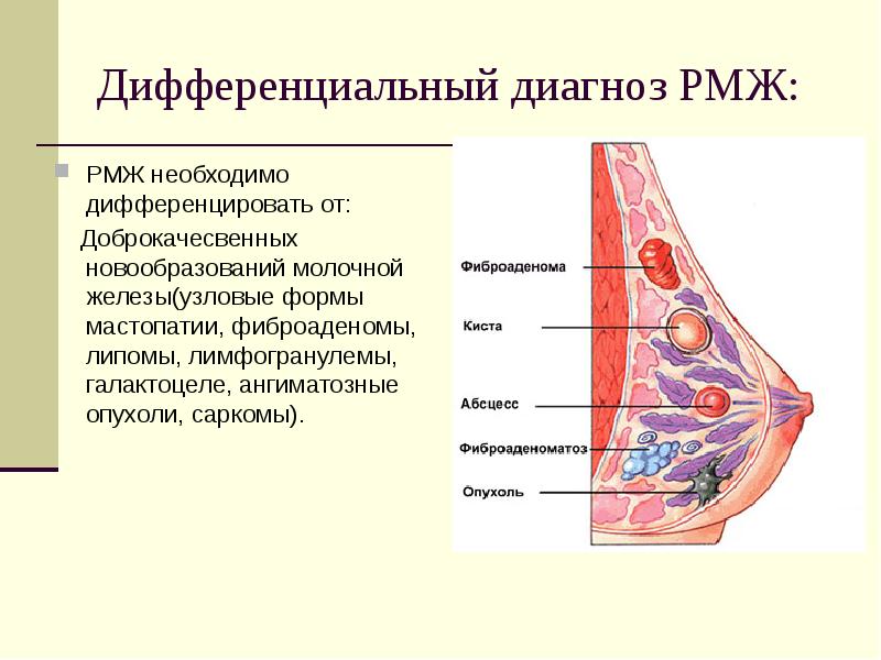 Опухоли молочной железы презентация