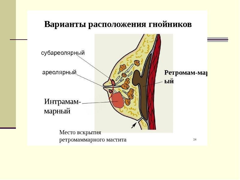 Молочные железы презентация. Опухоль молочной железы. Железу.