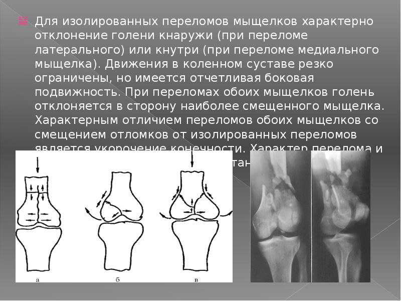 Внутрисуставной перелом мыщелка. Перелом наружного мыщелка большеберцовой кости рентген. Медиальный мыщелок бедренной кости коленного сустава.