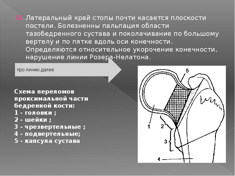 Перелом бедренной кости презентация