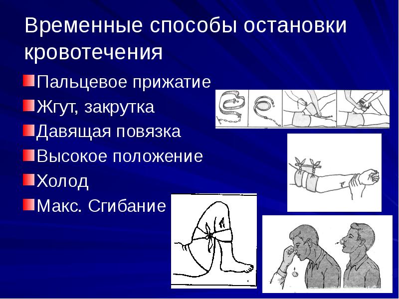 К временной остановке кровотечения относятся