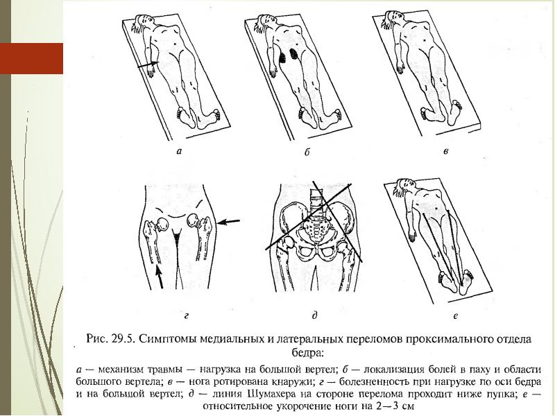 симптом перелома шейки бедренной кости. ротация плеча. укорочение конечности при переломе шейки бедра. тест на сопротивление подостной мышцы (наружной ротации). симптом, характерный для перелома костей таза.