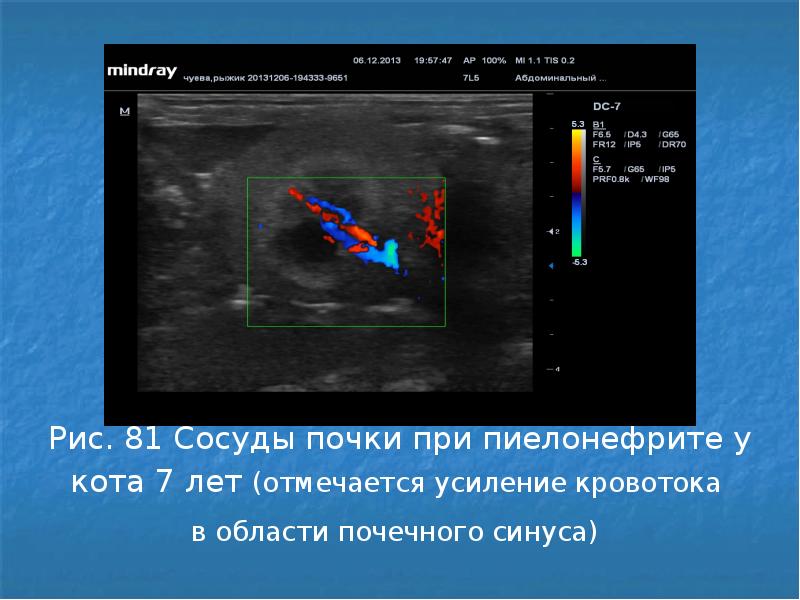 Уплотнение синусов обеих почек что это