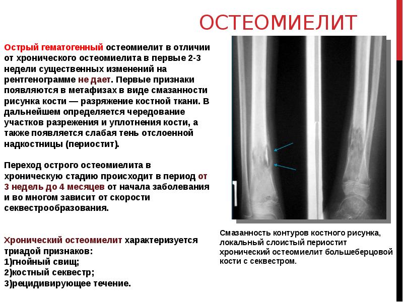 Гематогенный латынь. Хронический остеомиелит большеберцовой кости кт. Хронический остеомиелит большеберцовой кости рентген. Рентгенологические симптомы хронического остеомиелита. Остеомиелит секвестр на рентгене.