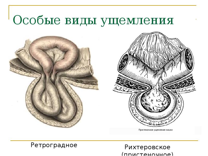 Грыжи презентация хирургические болезни