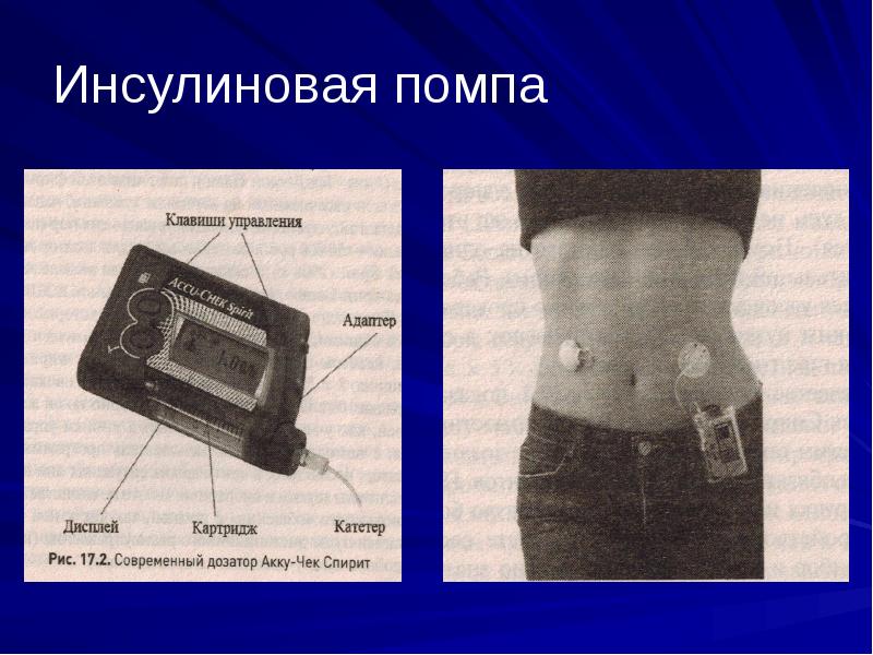 Инсулиновая помпа презентация