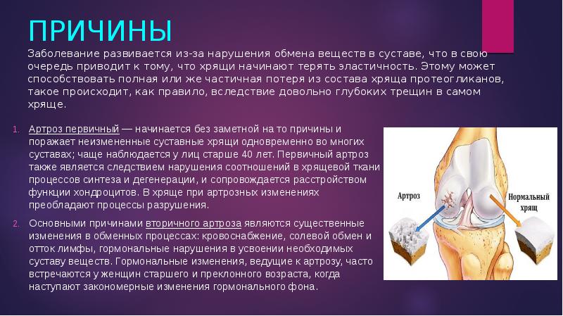 Презентация на тему артроз