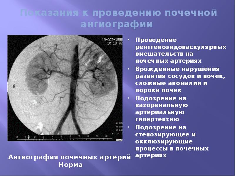 Почечная ангиография презентация