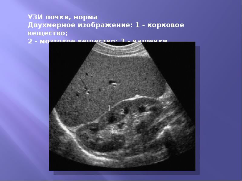 Нормальное узи. Измерение паренхимы почки на УЗИ. Размер паренхимы УЗИ почек. Паренхима почек на УЗИ норма. Норма размеров чашечек почек на УЗИ.