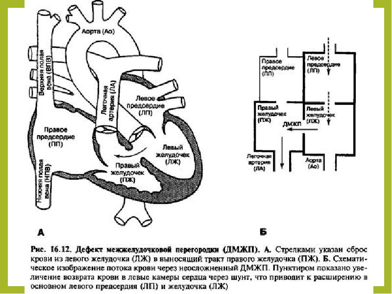 Дефект межжелудочковой перегородки презентация