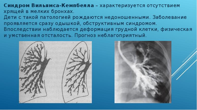 Синдром вильямса кэмпбелла презентация