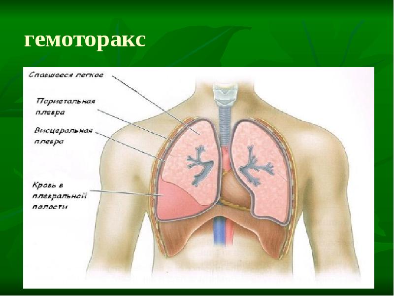Презентация пневмоторакс и гемоторакс