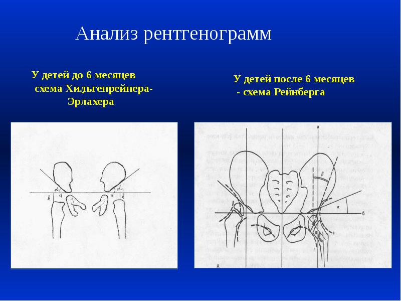 Схема врожденного вывиха бедра