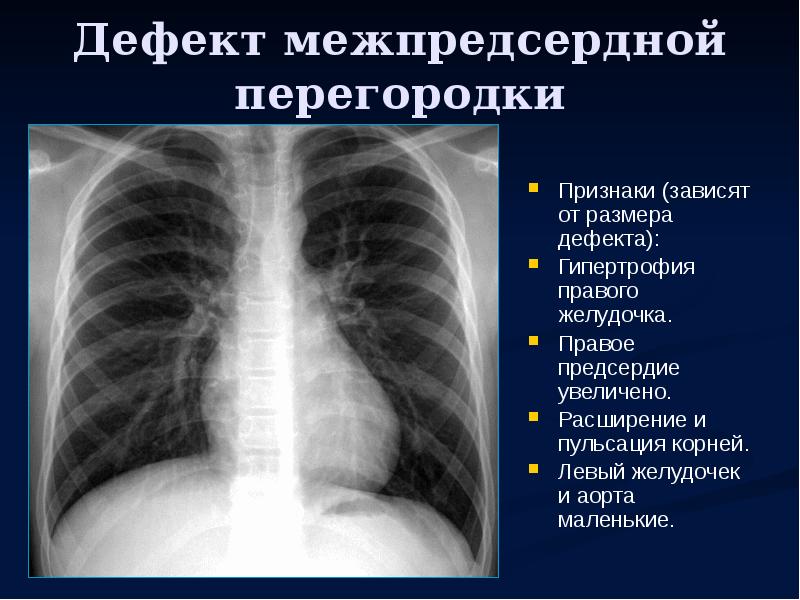 Дефект межпредсердной перегородки. Дефект межпредсердной перегородки рентген. Дефект предсердной перегородки.