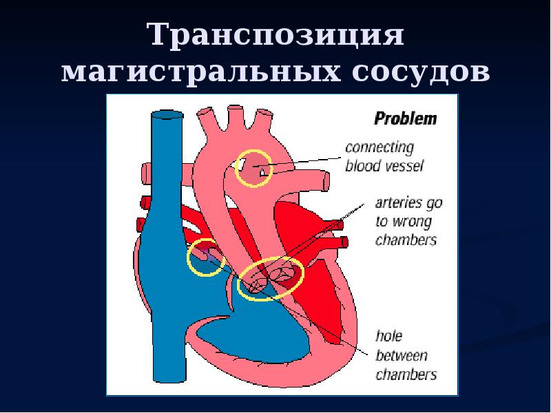 Транспозиция магистральных артерий презентация