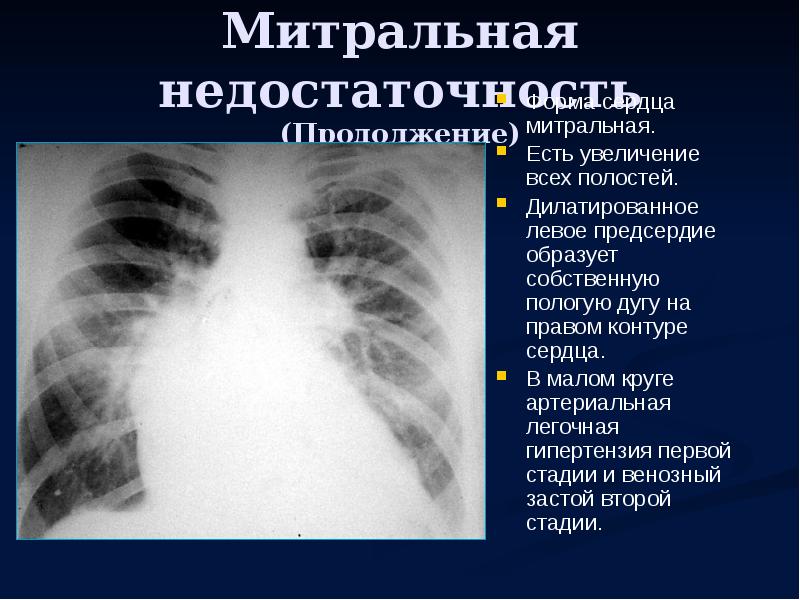 Увеличение правого. Рентген сердца при митральной недостаточности. Митральный порок сердца рентген признаки. Митральная недостаточность конфигурация сердца. Рентгенография при митральной недостаточности.